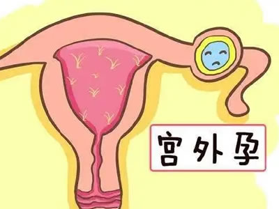 警惕！這些女性更易患宮外孕