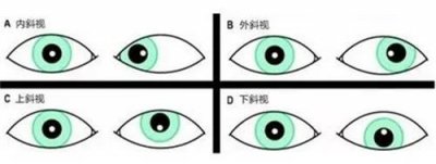 斜視治療不及時，可能會耽誤孩子一輩子